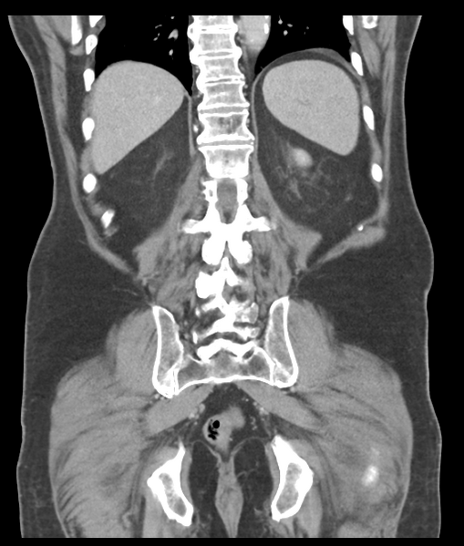 File:Adenocarcioma of rectum- T1 lesion (Radiopaedia 36921-38547 Coronal C+ portal venous phase 48).png