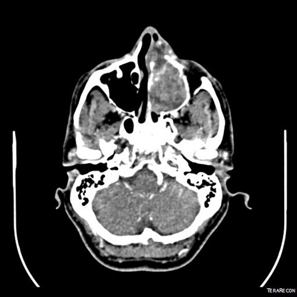 File:Adenoid cystic carcinoma involving paranasal sinus (Radiopaedia 16580-16283 Axial C+ arterial phase 3).jpeg