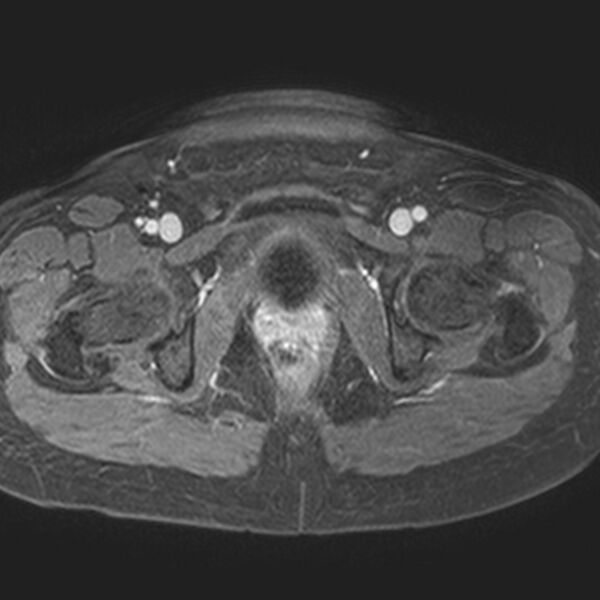 File:Adenomyoma of the uterus (Radiopaedia 9871-10439 Axial T1 C+ fat sat 5).jpg