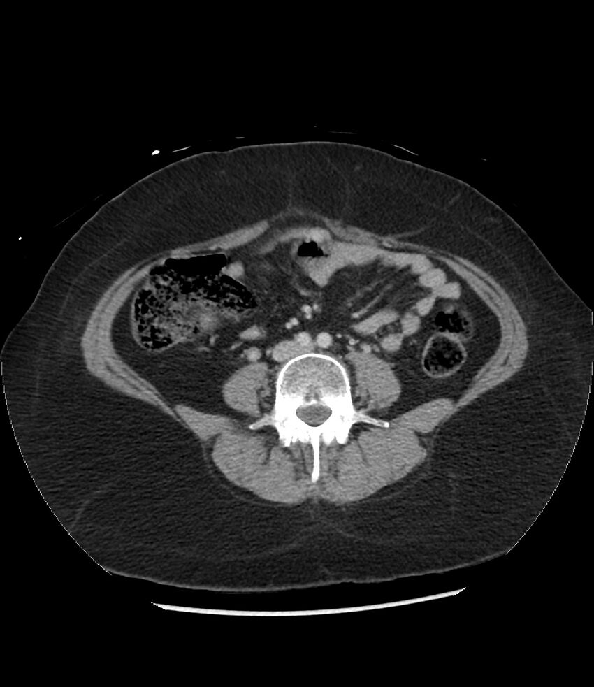 Adrenal cortical carcinoma with IVC invasion and thrombosis (Radiopaedia 34307-35597 Axial C+ portal venous phase 54).jpg