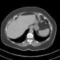 Adrenal hemangioma (Radiopaedia 33078-34103 Axial non-contrast 8).png
