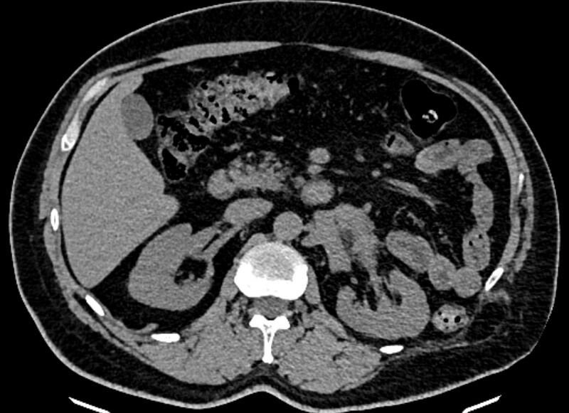 File:Adrenal metastases (Radiopaedia 73082-83791 Axial non-contrast 72).jpg