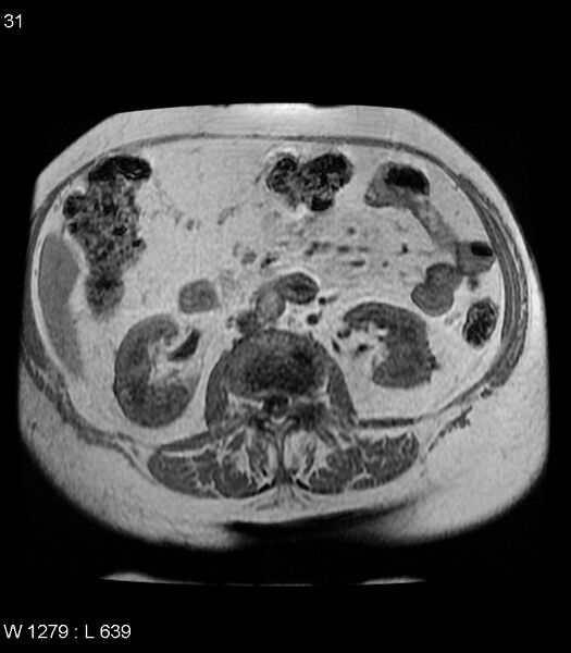 File:Adrenal myelolipoma (Radiopaedia 6765-7961 Axial T1 in-phase 31).jpg
