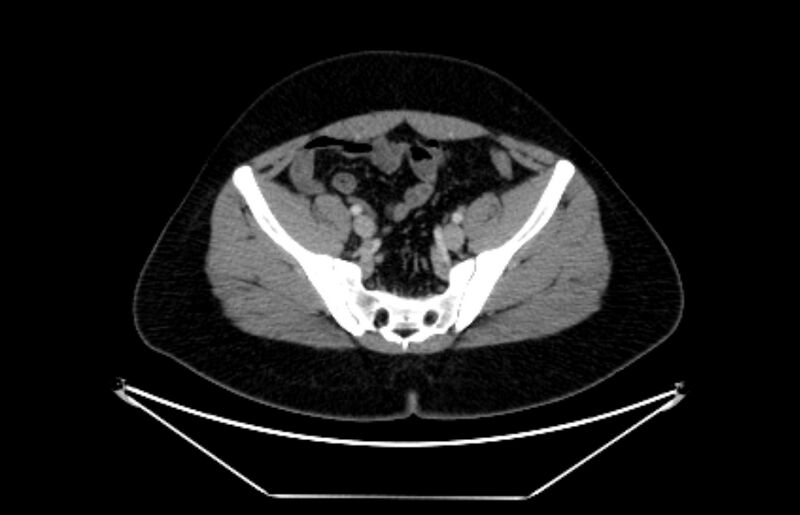 File:Adrenocortical carcinoma (Radiopaedia 80134-93438 Axial C+ portal venous phase 104).jpg