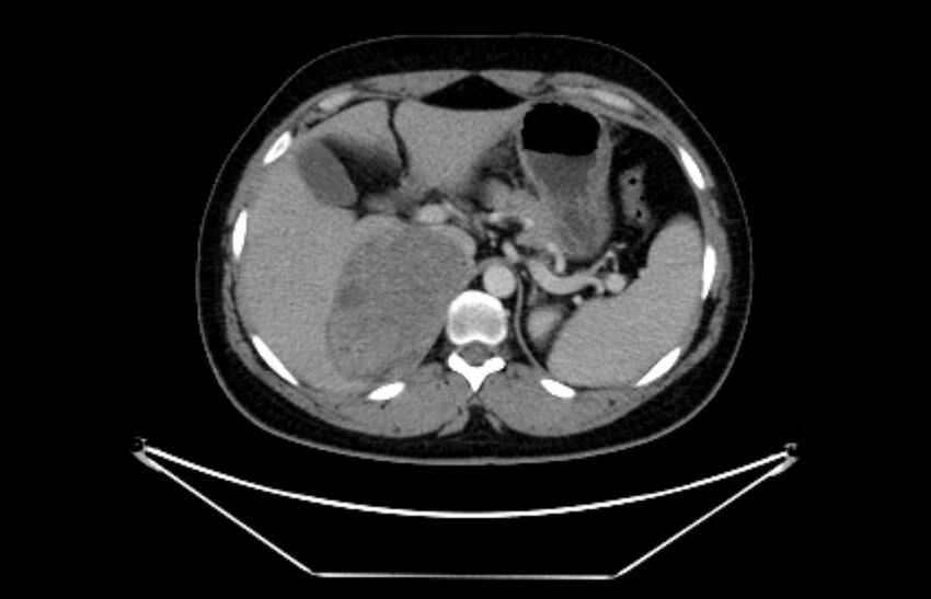 Adrenocortical carcinoma (Radiopaedia 80134-93438 Axial C+ portal venous phase 35).jpg