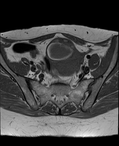File:Adult granulosa cell tumor of the ovary (Radiopaedia 71581-81950 Axial T1 10).jpg