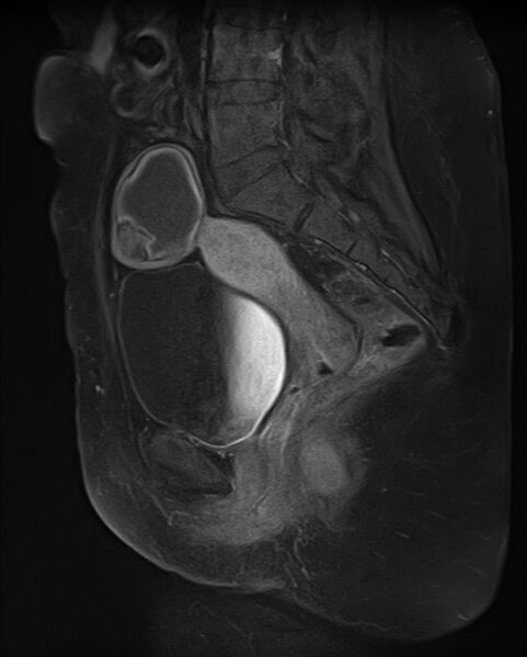 File:Adult granulosa cell tumor of the ovary (Radiopaedia 71581-81950 Sagittal T1 C+ fat sat 13).jpg