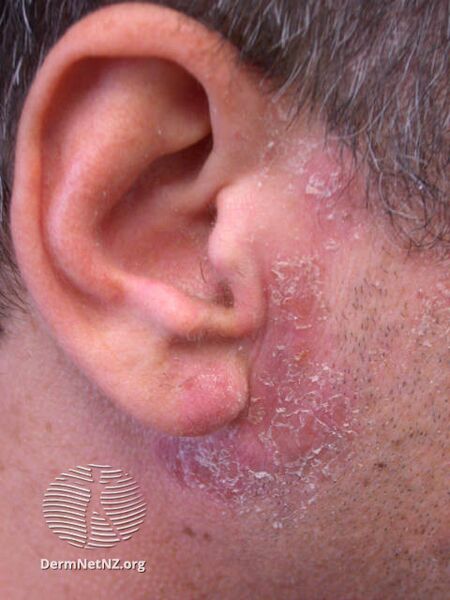 File:Airborne dermatitis due to epoxy allergy (DermNet NZ dermatitis-epoxy-face).jpg