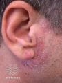 Airborne dermatitis due to epoxy allergy (DermNet NZ dermatitis-epoxy-face).jpg