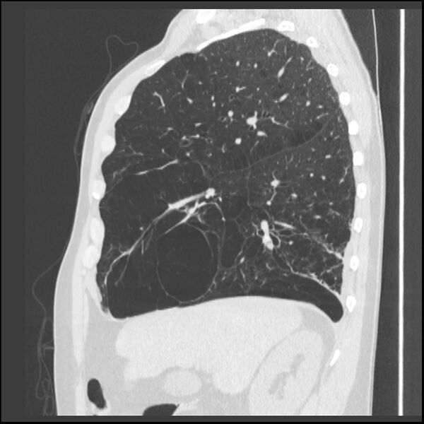 File:Alpha-1-antitrypsin deficiency (Radiopaedia 40993-43722 Sagittal lung window 187).jpg