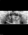 Ameloblastoma (Radiopaedia 18115-17900 Orthopantomogram 1).jpg