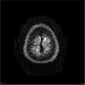 Amnestic syndrome secondary to hypoxic brain injury (Radiopaedia 24743-25004 DWI 30).jpg