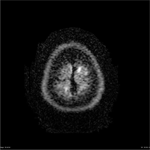 File:Amnestic syndrome secondary to hypoxic brain injury (Radiopaedia 24743-25004 DWI 30).jpg