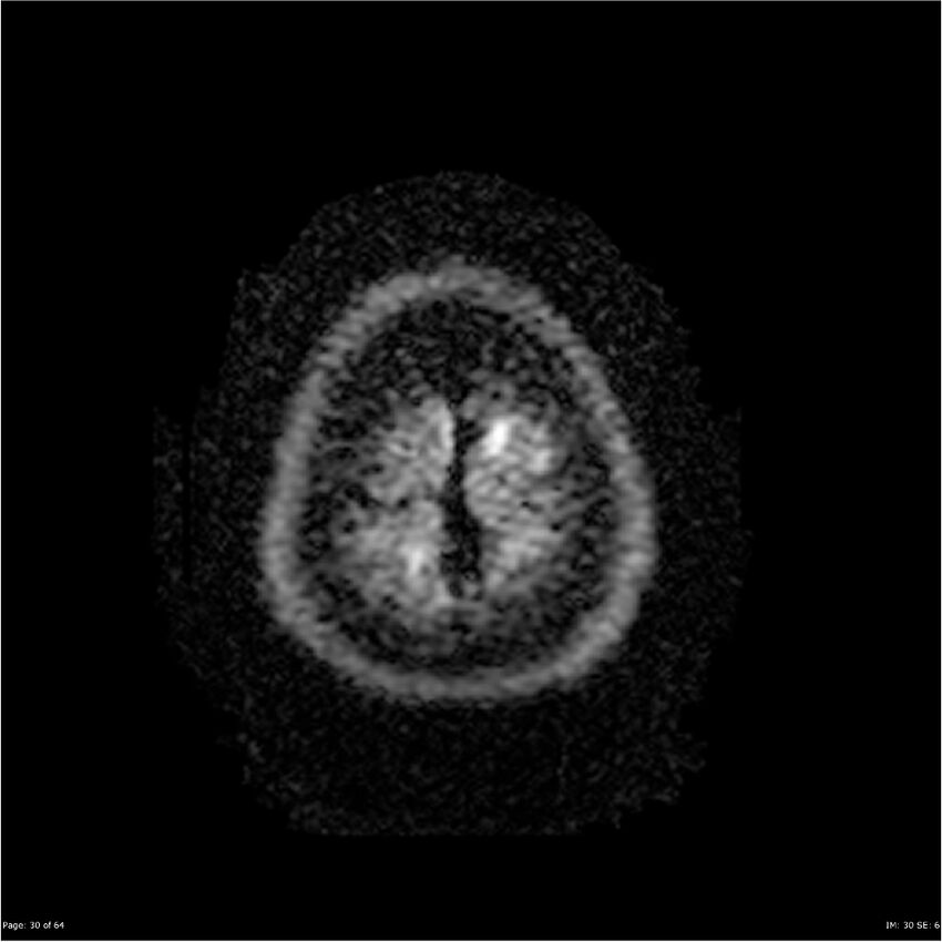 Amnestic syndrome secondary to hypoxic brain injury (Radiopaedia 24743-25004 DWI 30).jpg