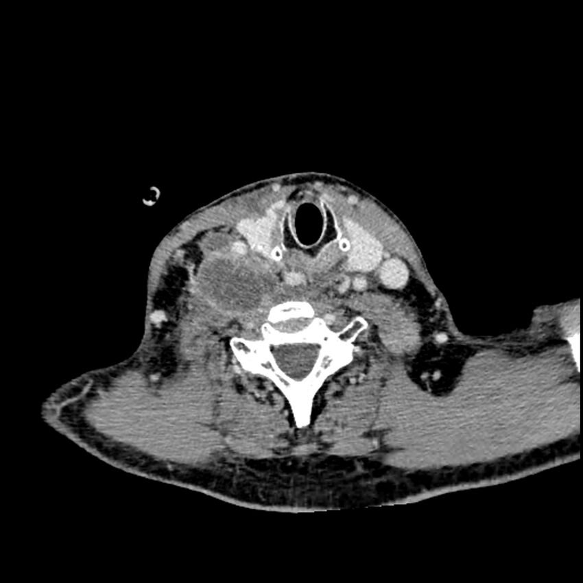 Anaplastic thyroid carcinoma (Radiopaedia 79087-92034 B 50).jpg