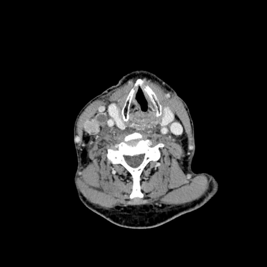 Anaplastic thyroid carcinoma (Radiopaedia 79087-92034 B 58).jpg