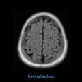Anatomy- sulci of the brain (Radiopaedia 33834-34995 Central sulcus 1).jpg