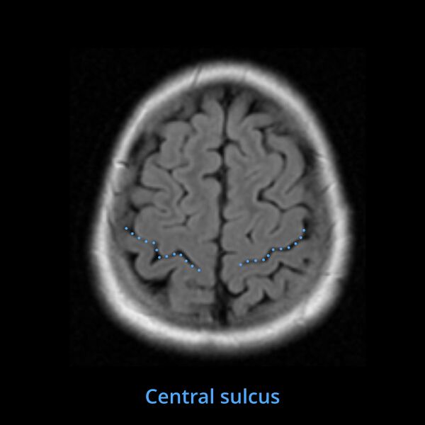 File:Anatomy- sulci of the brain (Radiopaedia 33834-34995 Central sulcus 1).jpg