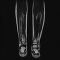 Aneurysmal bone cyst - tibia (Radiopaedia 22343-22367 Coronal T2 12).jpg