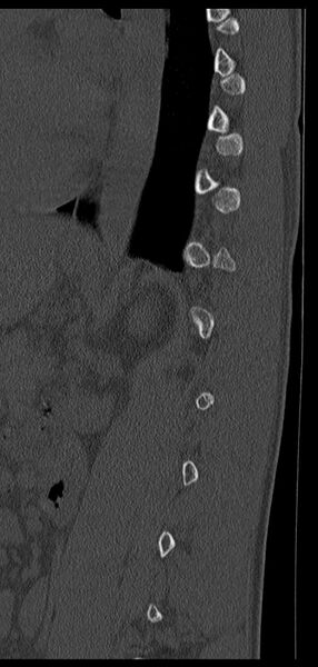 File:Aneurysmal bone cyst T11 (Radiopaedia 29294-29721 Sagittal bone window 21).jpg