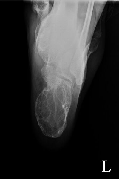 File:Aneurysmal bone cyst of the calcaneus (Radiopaedia 60669-68416 Axial view 1).jpg