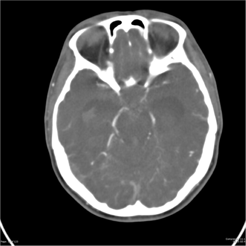 Aneurysmal subarachnoid hemorrhage and Moya Moya disease (Radiopaedia 34306-35593 Axial CT COW 35).jpg