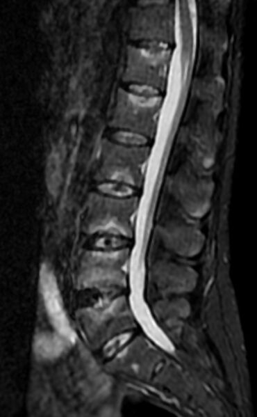 File:Ankylosing spondylitis - Andersson lesion (Radiopaedia 81878-95838 Sagittal STIR 7).jpg