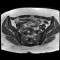 Ano-vaginal fistula (Radiopaedia 29765-30284 Axial T1 25).jpg