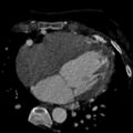 Anomalous left coronary artery from the pulmonary artery (ALCAPA) (Radiopaedia 40884-43586 A 47).jpg