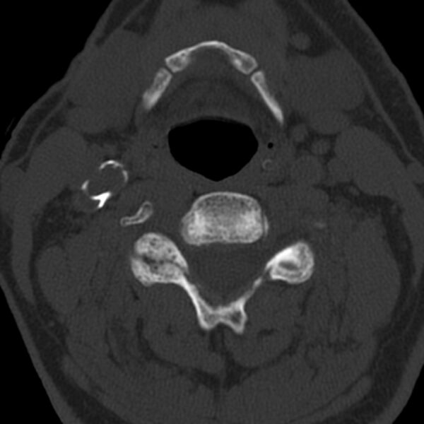 File:Anterior cervical postdiscectomy arthrodesis (Radiopaedia 32678-33646 Axial bone window 38).jpg