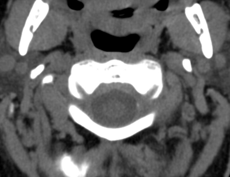 File:Anterior cervical postdiscectomy arthrodesis (Radiopaedia 32678-33646 Axial non-contrast 16).jpg