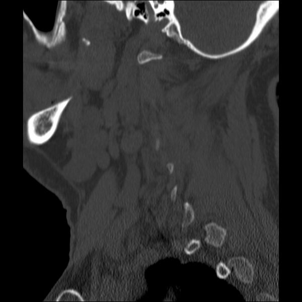File:Anterior cervical postdiscectomy arthrodesis (Radiopaedia 32678-33646 Sagittal bone window 66).jpg