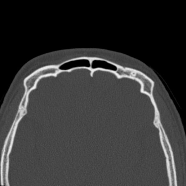 File:Antrochoanal polyp (Radiopaedia 21894-21868 Axial bone window 43).jpg