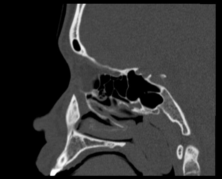 File:Antrochoanal polyp (Radiopaedia 21894-21868 Sagittal bone window 25).jpg