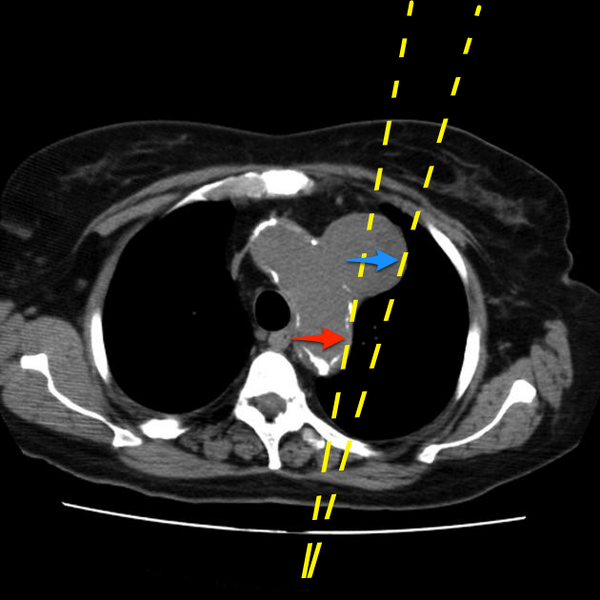 File:Aortic arch pseudoaneurysm (Radiopaedia 8534-20290 D 1).png