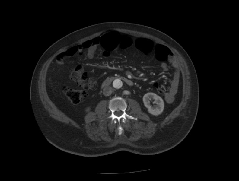 File:Aortic dissection (Radiopaedia 28802-29105 A 64).jpg