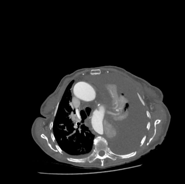 File:Aortic dissection (Radiopaedia 68763-78691 A 17).jpeg