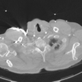 Aortic dissection - DeBakey type II (Radiopaedia 64302-73082 Axial lung window 5).png
