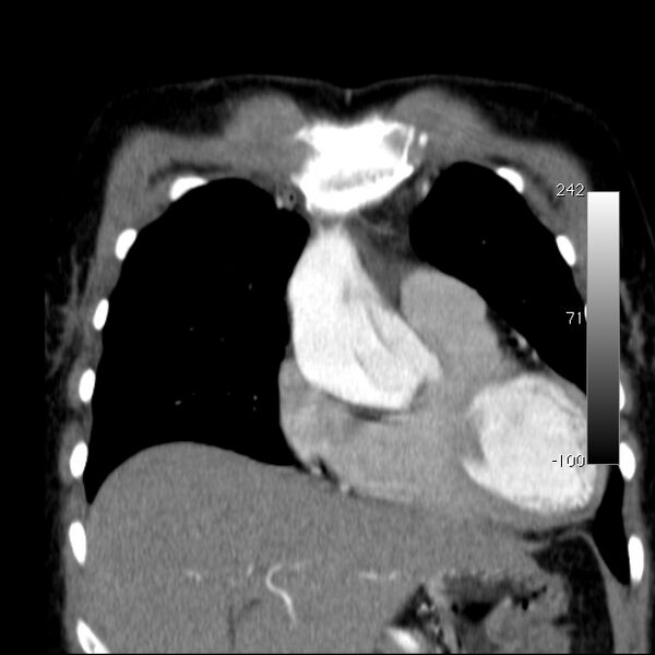 File:Aortic dissection - Stanford type A (Radiopaedia 29247-29659 B 18).jpg