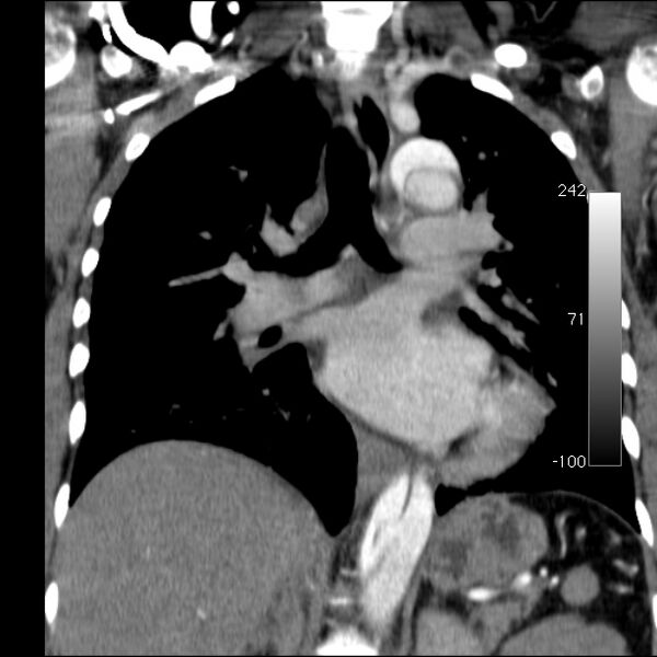 File:Aortic dissection - Stanford type A (Radiopaedia 29247-29659 B 35).jpg