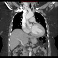 Aortic valve stenosis (Radiopaedia 14480-14423 A 10).jpg