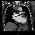 Aorto-coronary bypass graft aneurysms (Radiopaedia 40562-43157 B 23).png
