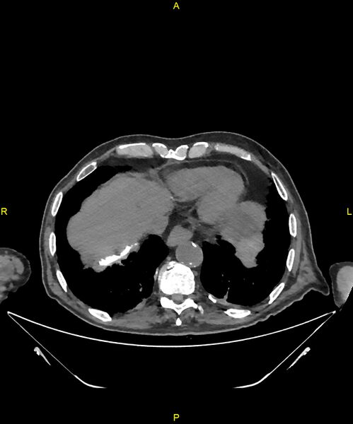 File:Aortoenteric fistula (Radiopaedia 84308-99603 Axial non-contrast 15).jpg
