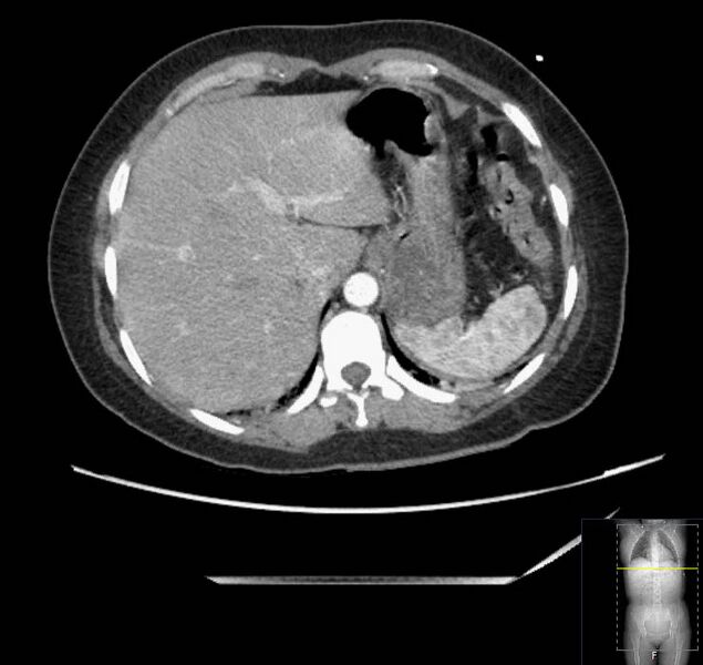 File:Appendicitis (CT angiogram) (Radiopaedia 154713-127660 Axial 162).jpg