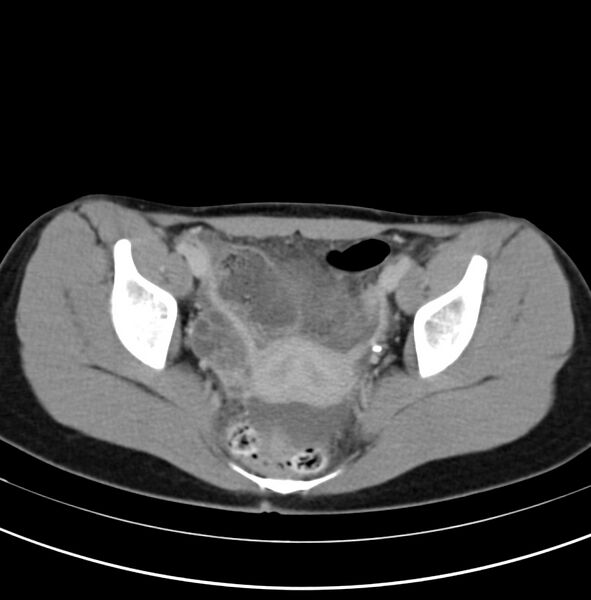 File:Appendicitis and incidental bicornuate uterus (Radiopaedia 22833-22853 Axial C+ delayed 35).jpg