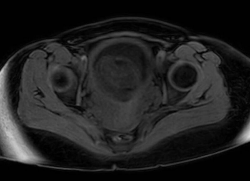 File:Appendicitis in gravida (MRI) (Radiopaedia 89433-106395 Axial DIXON 135).jpg