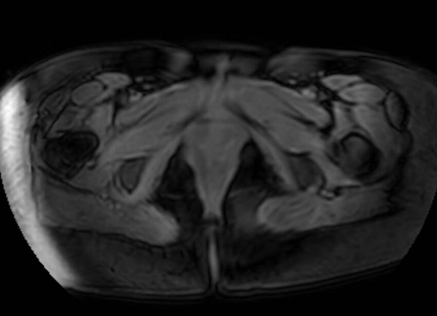 Appendicitis in gravida (MRI) (Radiopaedia 89433-106395 Axial DIXON 156).jpg