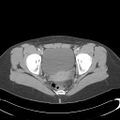 Appendicitis with minimal stranding but appendicolith (Radiopaedia 29035-29397 A 77).jpg