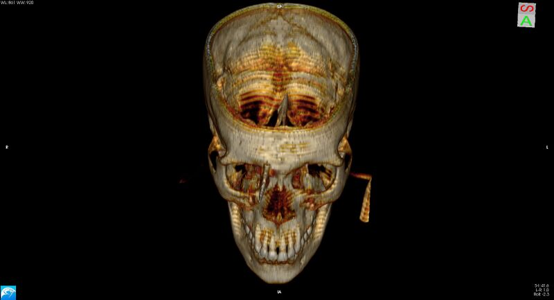 File:Arrow injury to the brain (Radiopaedia 72101-82607 3D bone 11).jpg