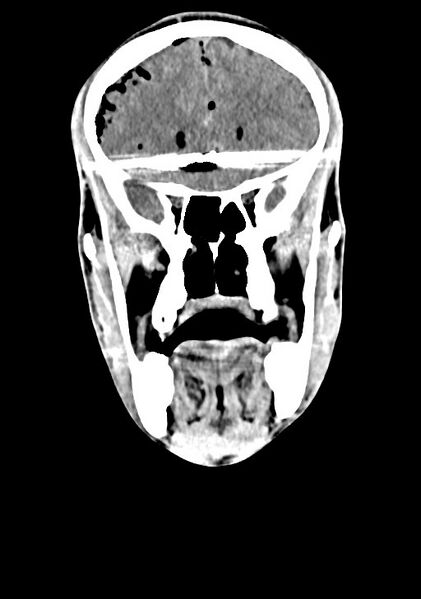 File:Arrow injury to the brain (Radiopaedia 72101-82607 Coronal non-contrast 29).jpg